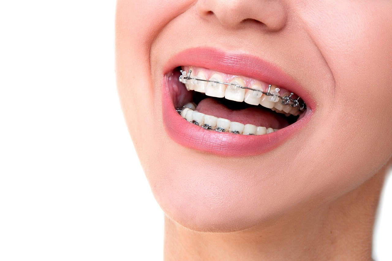 metal-braces Metal Braces